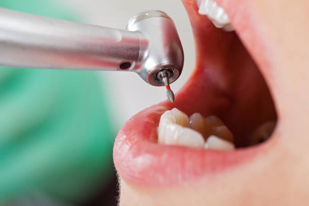 Best Emergency Tooth Extraction in Riverside, IA